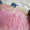 掌蹠膿疱症再発・巻き爪・手湿疹・頭皮湿疹様々な皮膚の症状の発症